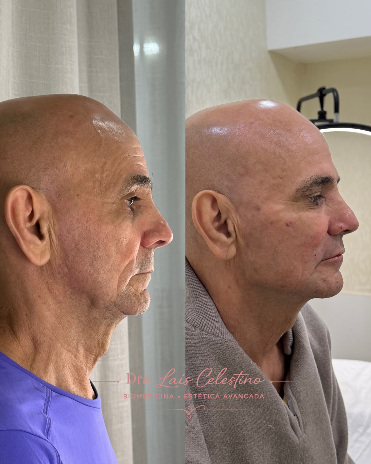 Resultado real de planejamento facial 2